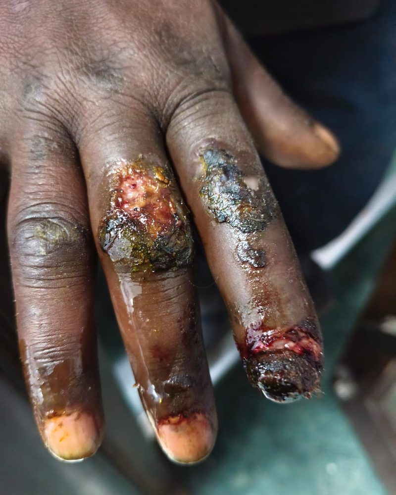 A patient’s injured fingers with open wounds, before treatment