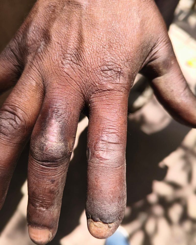 The patient’s fingers after healing